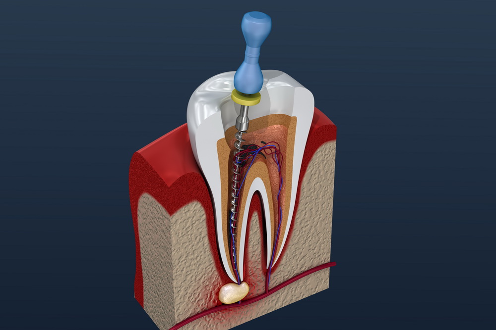 Leczenie kanałowe endodoncja